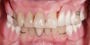 Up close image full Mouth Rehabilitation before