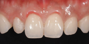 Veneers front view