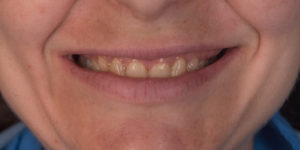 Severely Worn Down Dentition- Full Mouth Rehabilitation -before