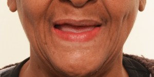 Smiling man with Removable Complete Dentures
