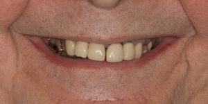 Front view before  Full Mouth Rehabilitation	