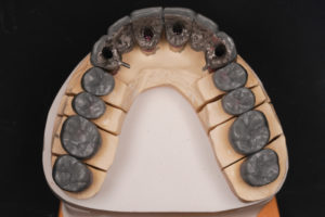 Bottom teeth mold of Full Mouth Rehabilitation