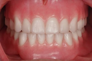 A mount showing Removable Complete Dentures