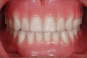 A mount showing Removable Complete Dentures