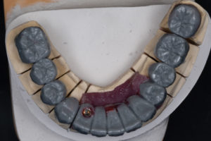 Mold of a overbite- bottom teeth