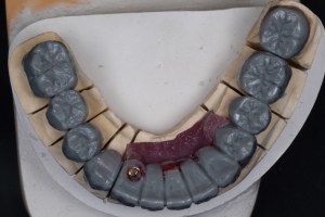 Mold of a overbite- bottom teeth