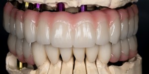 Full mount Rehabilitation after prior to implant 