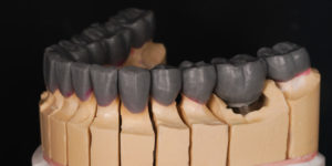 Mold of  Full Mouth Rehabilitation	- bottom teeth 