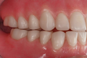 A mount showing Removable Complete Dentures