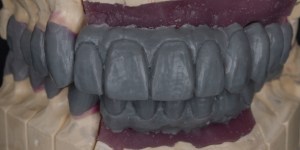 Mold of a overbite- Full Mouth 