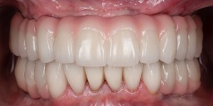 Full mount Rehabilitation after implant