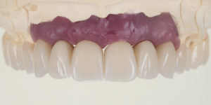  Mold of Full Mouth Rehabilitation- top teeth 