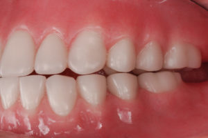 A mount showing Removable Complete Dentures side view