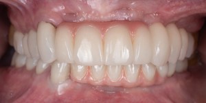 Deep Overbite- Full Mouth Rehabilitation front view