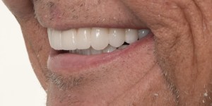 Deep Overbite- Full Mouth Rehabilitation side view