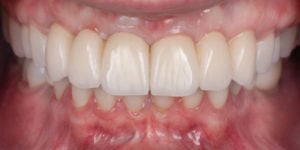 After Full Mouth Rehabilitation full mouth view 