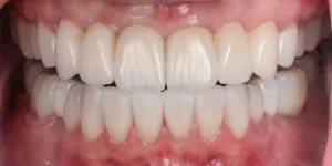 After Full Mouth Rehabilitation full mouth view 