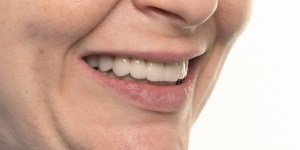 Smiling woman with a full Mouth Rehabilitation
