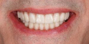 smiling man with Implant Retained Fixed Prosthesis