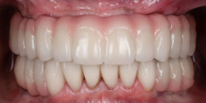 up close image full Mouth Rehabilitation after