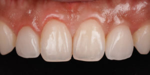 Veneers front view 