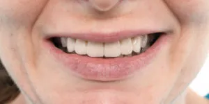 Full Mouth Rehabilitation -after