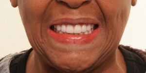 Smiling man with Complete Dentures