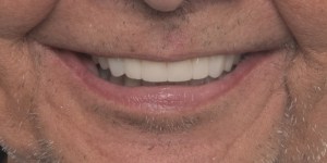 Front view after full Mouth Rehabilitation	