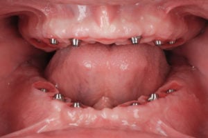 Open mouth with Implant Retained Fixed Prosthesis with no teeth