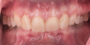 Severely Worn Down Dentition- Full Mouth Rehabilitation -before close up
