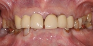 Front view before full Mouth Rehabilitation