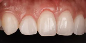 Veneers left side view of front teeth