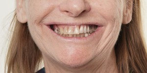 Implants and Teeth Mixed- Full Mouth Rehabilitation before