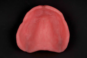 Mold of Removable Complete Dentures