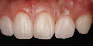 Veneers right side view of front teeth 