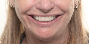 Implants and Teeth Mixed- Full Mouth Rehabilitation after