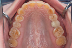 Severely Worn Down Dentition- Full Mouth Rehabilitation top aerial view