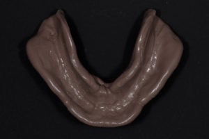 Mold of Removable Complete Dentures