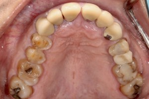 Deep Overbite- Full top Mouth Rehabilitation before 