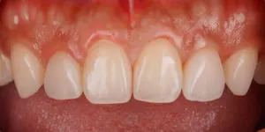Veneers fron teeth