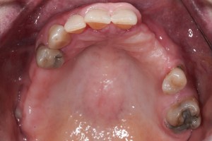 Implants and Teeth Mixed- Full Mouth Rehabilitation before