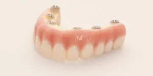  Implant Retained Fixed Prosthesis