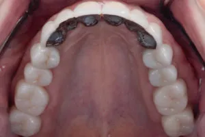 After Full Mouth Rehabilitation top aerial view