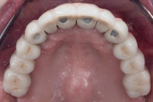 Implants and Teeth Mixed- Full Mouth Rehabilitation after