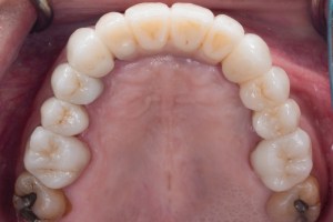 Deep Overbite- Full top Mouth Rehabilitation after