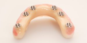  Implant Retained Fixed Prosthesis