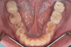 Severely Worn Down Dentition- Full Mouth Rehabilitation top aerial view before