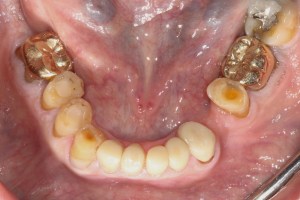 Deep Overbite-  Full Mouth Rehabilitation