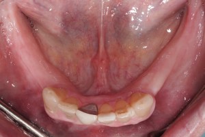 Implants and Teeth Mixed- Full Mouth Rehabilitation before