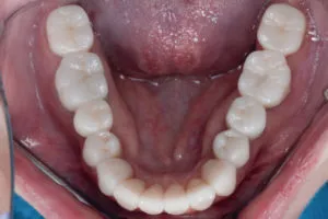 Full Mouth Rehabilitation top aerial view after